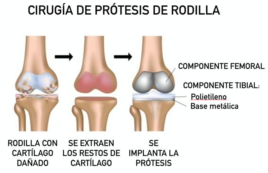 Protesis de rodilla postoperatorio